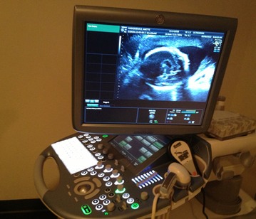 Ultrasound of lanugo.JPG